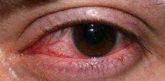 आँखा पाक्ने रोगबाट लमजुङमा २ हजार ७३३ जना संक्रमित